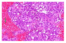 Figure 8: Cell block case showing microfollicles lined by enlarged cells H&E X200.